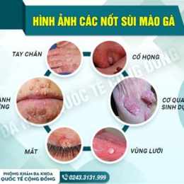 ai đã chữa khỏi bệnh sùi mào gà