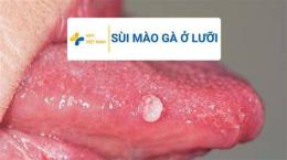 ảnh chụp màn hình ai đã chữa khỏi bệnh sùi mào gà