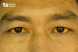 ảnh chụp màn hình bệnh vàng da ở gà
