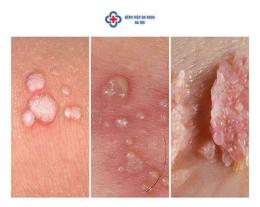 ảnh chụp màn hình bệnh viện da liễu sùi mào gà