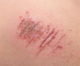 ảnh chụp màn hình bị trầy xước da ăn thịt gà được không