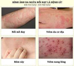 ảnh chụp màn hình da bị nổi hột giống da gà