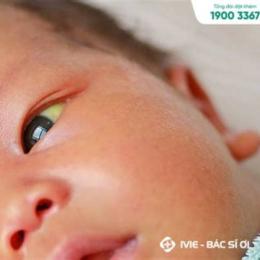 bé bị vàng da mẹ ăn trứng ga được không