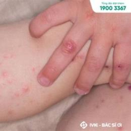 bé sốt nhưng tay chân nổi da gà