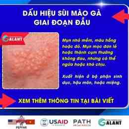 benh da ga o nguoi