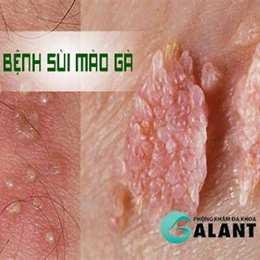 benh vien da lieu tri sui mao ga