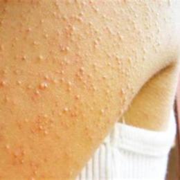 bị ngứa như nổi da gà