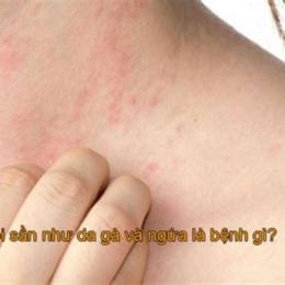 bị nổi da gà và ngứa