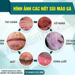 chữa bệnh sùi mào gà ở bệnh viện da liễu tphcm