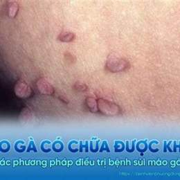 chữa sùi mào gà ở bệnh viện da liễu tp hcm