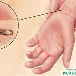 cổ nổi như da gà