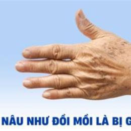 da cánh tay nổi nhiều vết giống như da gà