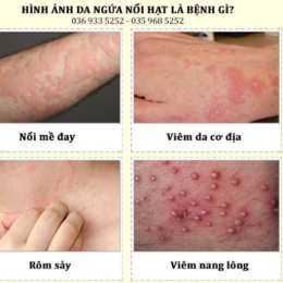 da nổi hột như da gà và ngứa