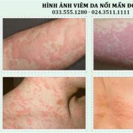 da nổi mẩn như da gà