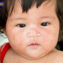 em bé sốt nổi da gà