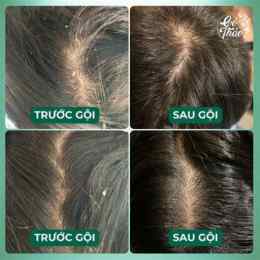 gàu da đầu close up
