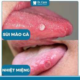 hướng dẫn sử dụng ai đã chữa khỏi bệnh sùi mào gà