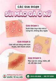 hướng dẫn sử dụng chữa sùi mào gà ở bệnh viện da liễu tp hcm