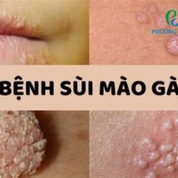 khám bệnh sùi mào gà ở đà nẵng
