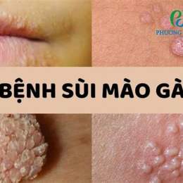 khám sùi mào gà ở bệnh viện da liễu tp hcm