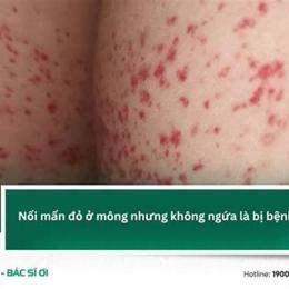mông nổi hột như da gà