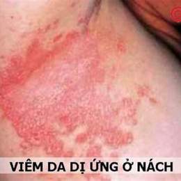 nách nổi da gà