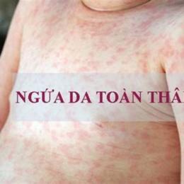 ngứa toàn thân nổi da gà
