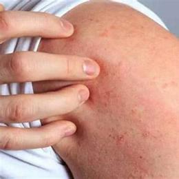 nổi hột như da gà