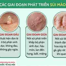sùi mào gà mọc trên da