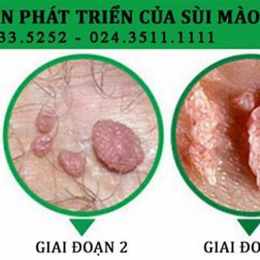 sùi mào gà ở da bìu