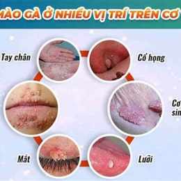 sùi mào gà ở da quy đầu