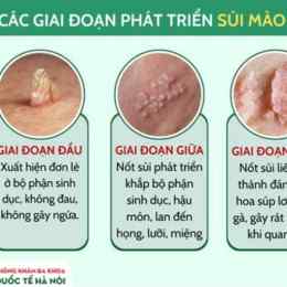sùi mào gà trên da tay