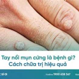 tay bị nổi hột như da gà