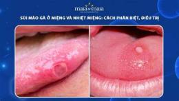 tính năng nổi bật benh vien da lieu tri sui mao ga