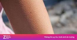 tính năng nổi bật bị nổi da gà ở tay