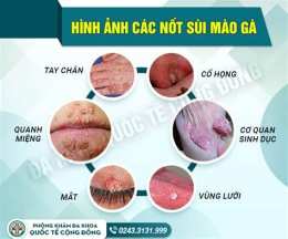 tính năng nổi bật chữa bệnh sùi mào gà ở bệnh viện da liễu