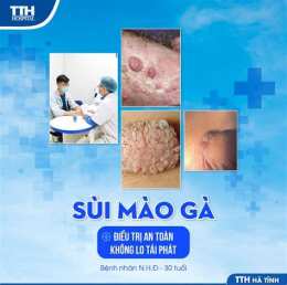 tính năng nổi bật chữa sùi mào gà ở viện da liễu trung ương
