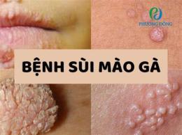 tính năng nổi bật đã có ai khỏi sùi mào gà chưa