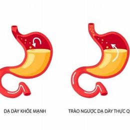 trào ngược dạ dày uống nước có ga được không
