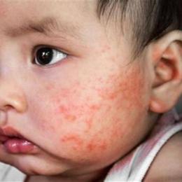 trẻ sốt bị nổi da gà