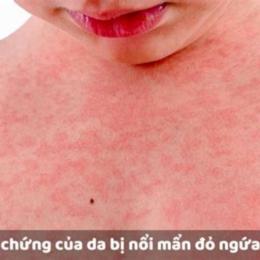 triệu chứng nổi da gà